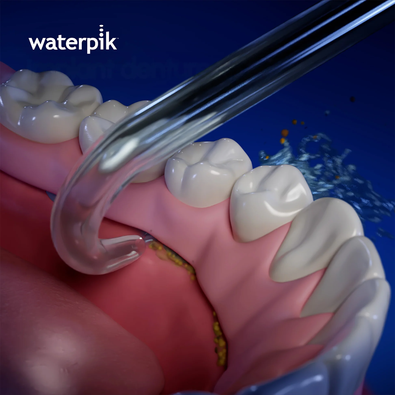 Waterpik™ Implant Denture Tip DT-100E. 2 Pack