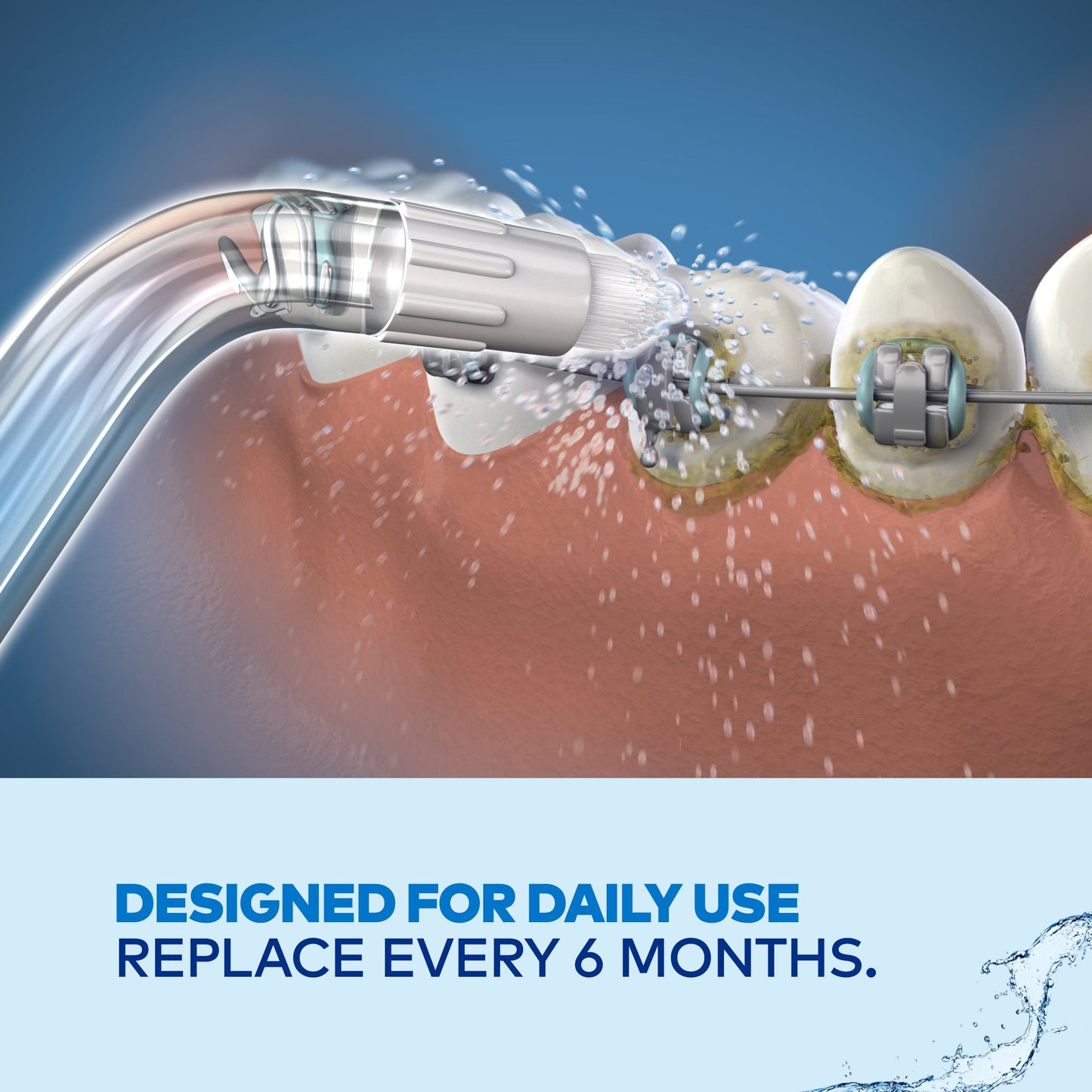 Waterpik WP OD-100E Orthodontic Tip